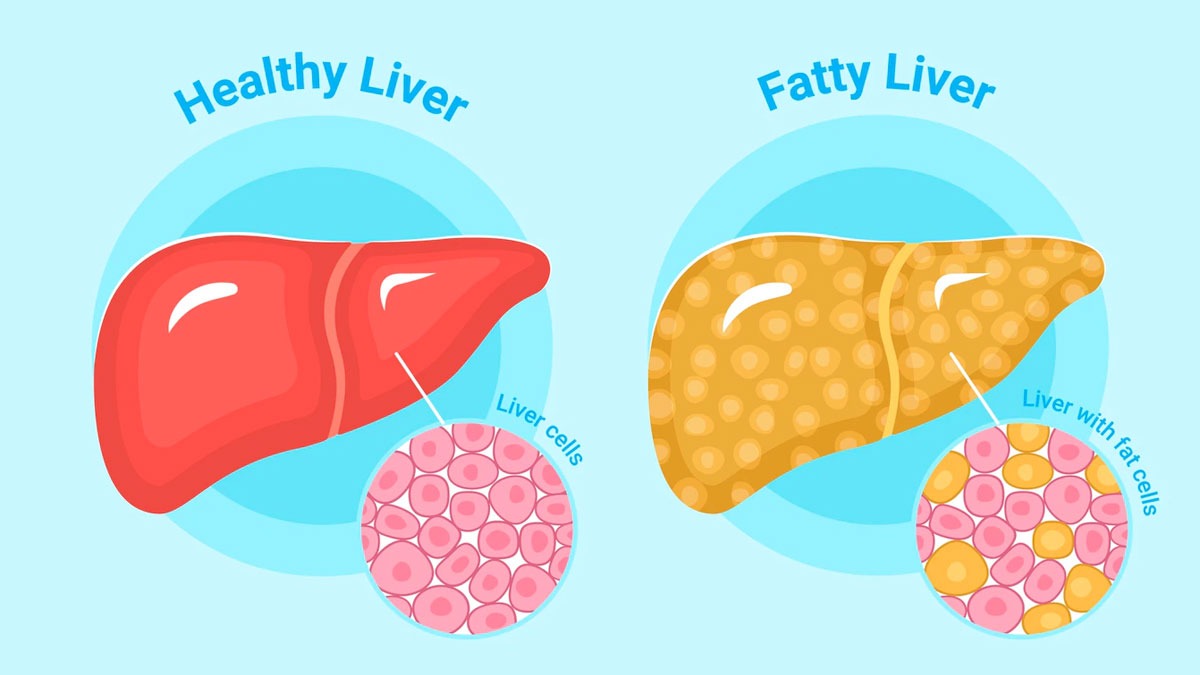 What to know about fatty liver disease?