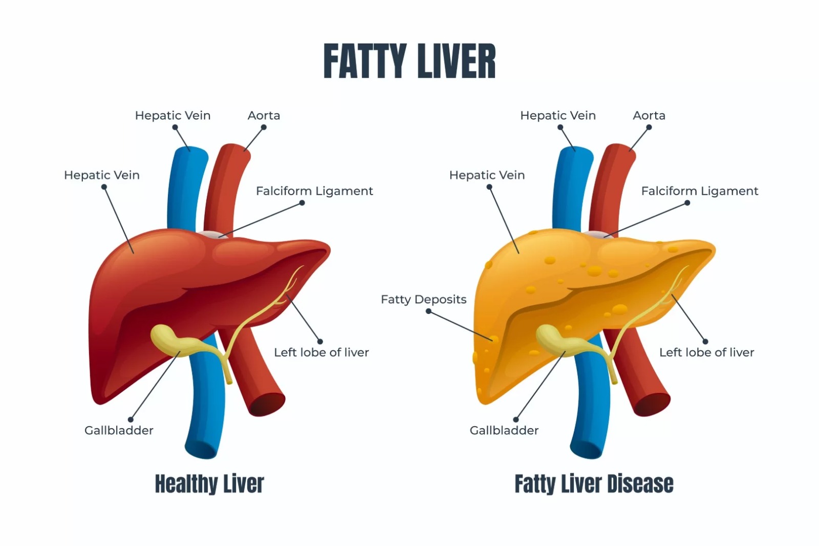 fatty-liver-disease-ineutra